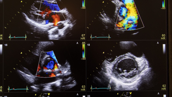 Pocket Ultrasound Reduces Hospital Stays for Patients with Shortness of Breath.