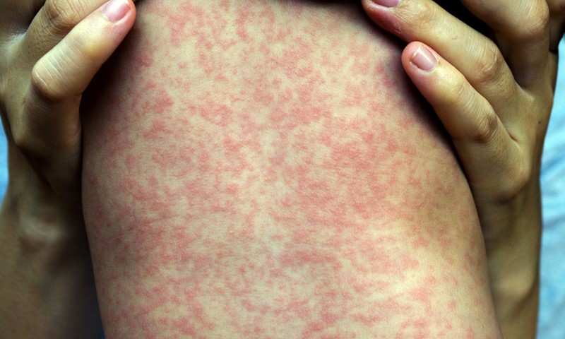 Measles case confirmed at Newark Liberty International Airport prompts health alert.