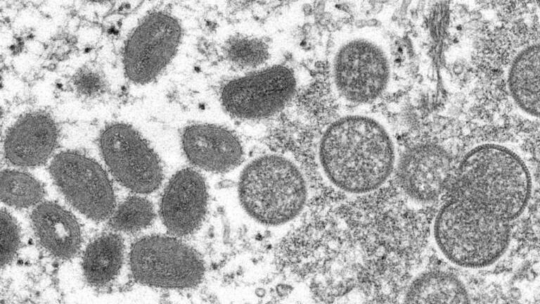 ‘This is a pox virus we know a lot about.’ Infectious disease experts in the region say monkeypox is familiar, preventable.
