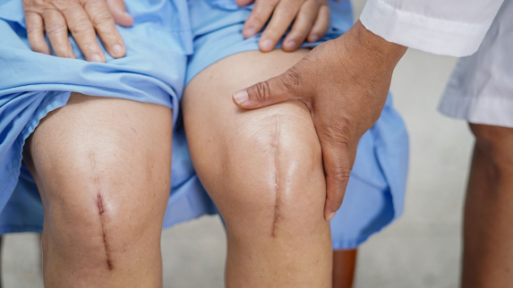 Long-Acting Opioids May Be Unnecessary in Study of Total Knee Replacement.