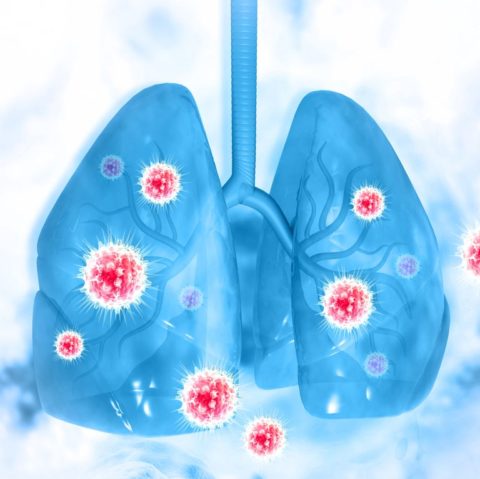 pneumonia complication